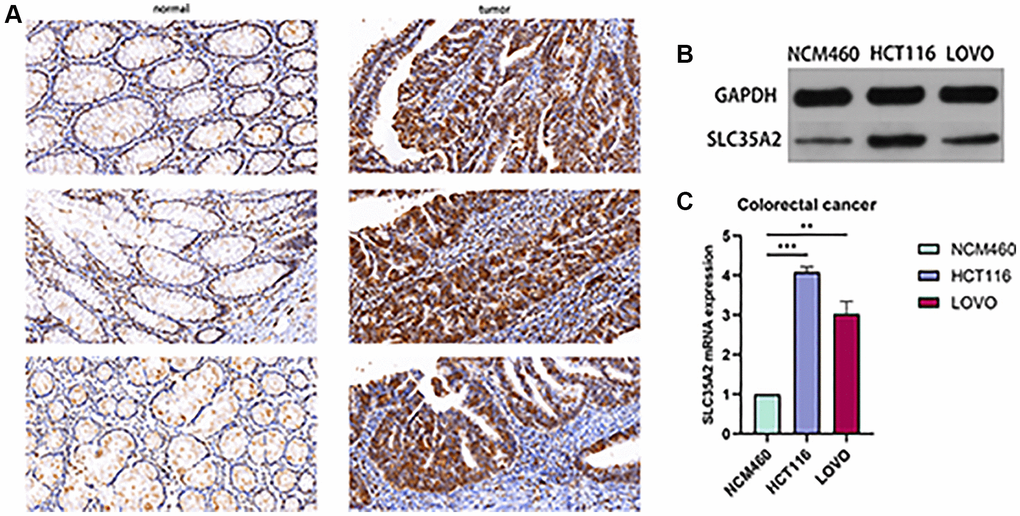 Expression of SLC35A2 in colorectal cancer tissues and cells. (A) Representative immunohistochemical staining of SLC35A2 in CRC tumor tissues and matched paracancerous tissues. Strong positive expression of SLC35A2 expression in CRC tissues, weak positive of SLC35A2 expression in matched paracancerous tissues. Scale bar = 50 μm. (B) Western blotting was used to detect the protein expression of SLC35A2 in intestinal epithelium (NCM460) and colorectal carcinoma (HCT116, LOVO). (C) qRT-PCR was used to validate SLC35A2 expression in colorectal carcinoma. (**p ***p 