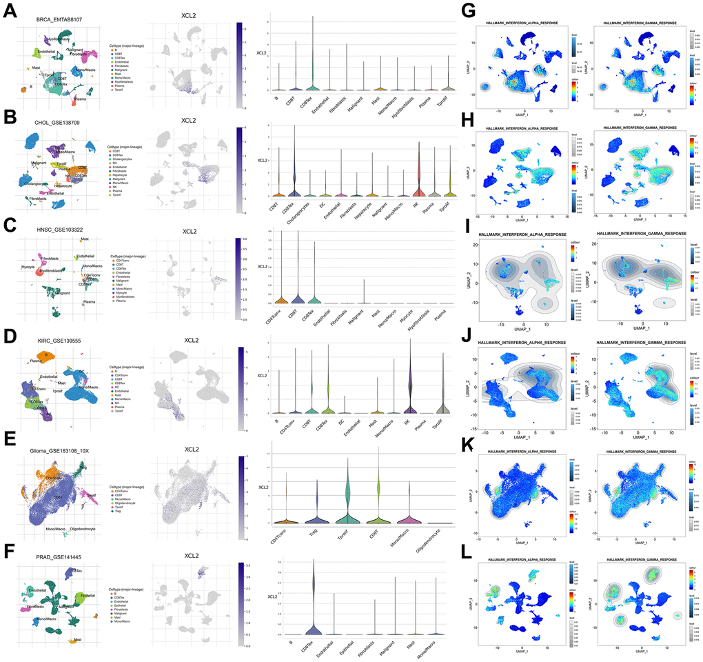 The scRNA-seq results of XCL2 expression and single-cell signature in pan-cancers. The definition of cancer cells in BRCA (A), CHOL (B), HNSC (C), KIRC (D), GBM (E), and PRAD (F). Enrichment analyses of interferon-alpha and interferon-gamma responses in BRCA (G), CHOL (H), HNSC (I), KIRC (J), GBM (K) and PRAD (L) single cell sequencing results.