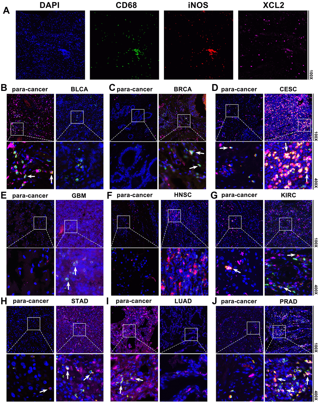 Pan-cancer samples and the associated para-cancerous tissues were stained using multiplex immunofluorescence. The typical picture of the staining for DAPI, CD68, iNOS, and XCL2 in pan-cancer samples is shown in (A). Red, green, and pink represent CD68-, iNOS-, and XCL2-positive cells, respectively. Blue denotes the DAPI-stained nucleus. (B) Bladder urothelial carcinoma (BLCA), (C) invasive breast carcinoma (BRCA), (D) cervical squamous cell carcinoma and endocervical adenocarcinoma (CESC), (E) glioblastoma multiforme (GBM), (F) head and neck squamous cell carcinoma (HNSC), (G) kidney renal clear cell carcinoma (KIRC), (H) stomach adenocarcinoma (STAD), (I) lung adenocarcinoma (LUAD), and (J) Prostate adenocarcinoma (PRAD). XCL2 and iNOS double-positive cells with 100× and 400× amplification are shown by the note.