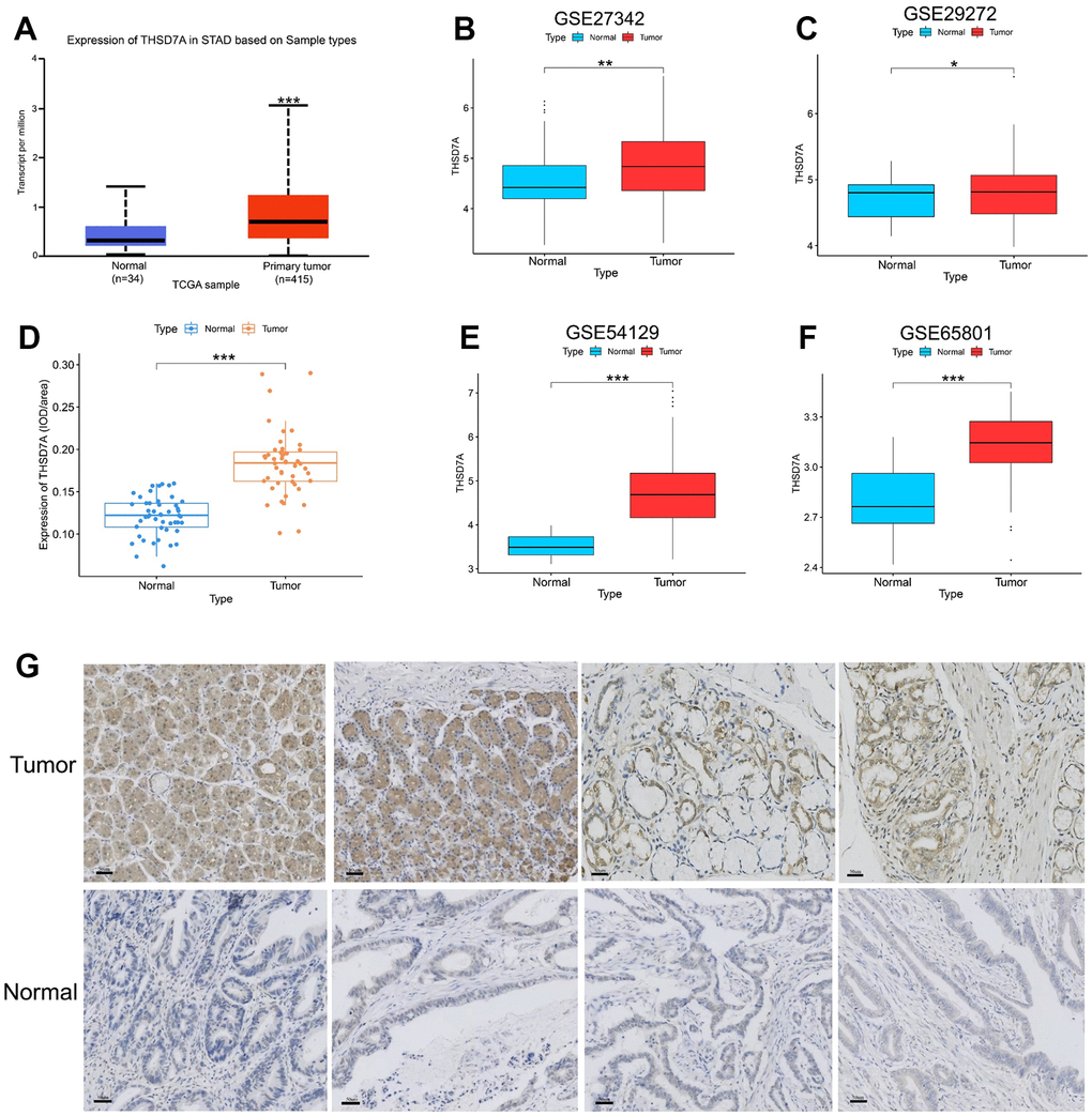 Analysis of THSD7A expression in the UALCAN database, TCGA database, GEO database, and tissue microarrays. Differential expression of THSD7A in the UALCAN database (A), GSE27342 (B), GSE29272 (C), GSE54129 (D), and GSE65801 (E) cohorts. (F, G) Differential expression of THSD7A in the tissue microarrays of gastric cancer verified via immunohistochemistry (scale bar = 50 μm) (*: P