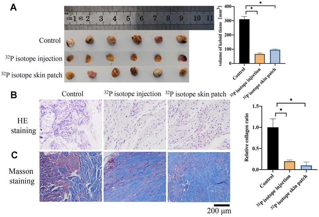 Both 32P isotope injection and skin path significantly reduce the size of keloid. (A) 32P isotope injection and skin path significantly reduced the size of keloid (n=6); (B) HE staining was performed to investigate the histological changes (n=3); (C) Masson's trichrome staining was performed to investigate the collagen deposition (n=3). * indicates p 