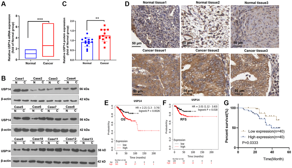 Alteration of USP14 expression in EC. (A–C) qRT-PCR (A) and WB (B, C) confirmed the USP14 level in EC tissues and paired adjacent normal tissues. (D) The Human Protein Atlas was used to analyze the USP14 profile in EC tissues and normal endometrial tissues. (E, F) The K-M plotter survival curve was adopted to clarify the correlation between USP14 and the overall survival (OS) and relapse-free survival (RFS) rates of EC patients. (G) The association between the USP14 level and the prognosis of EC patients was determined. **refers to P ***represents P 