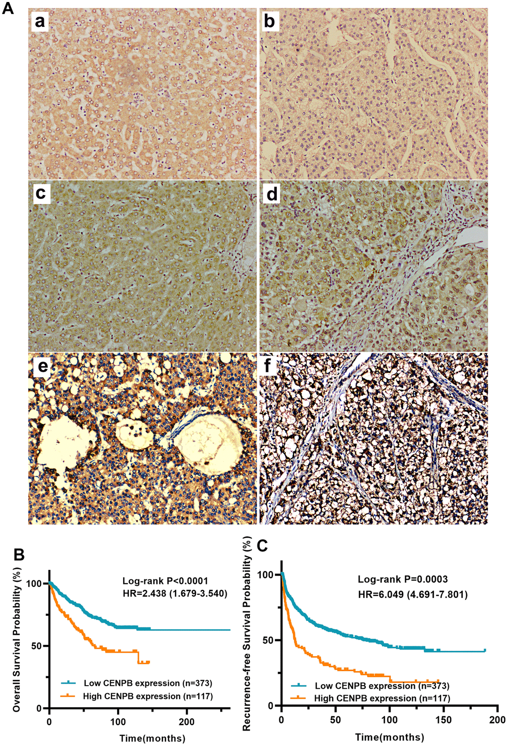 (A) CENPB protein expression and its prognostic value in a cohort with 490 HCC patients. (A) Representative IHC images of normal liver tissue (a) and HCC tissue with IHC scores 0 (b), 1 (c), 2 (d), 3 (e), and 4 (f), respectively, are shown below. (B, C) High expression of CENPB protein was found to be indicative of unfavorable OS (B) and RFS (C).