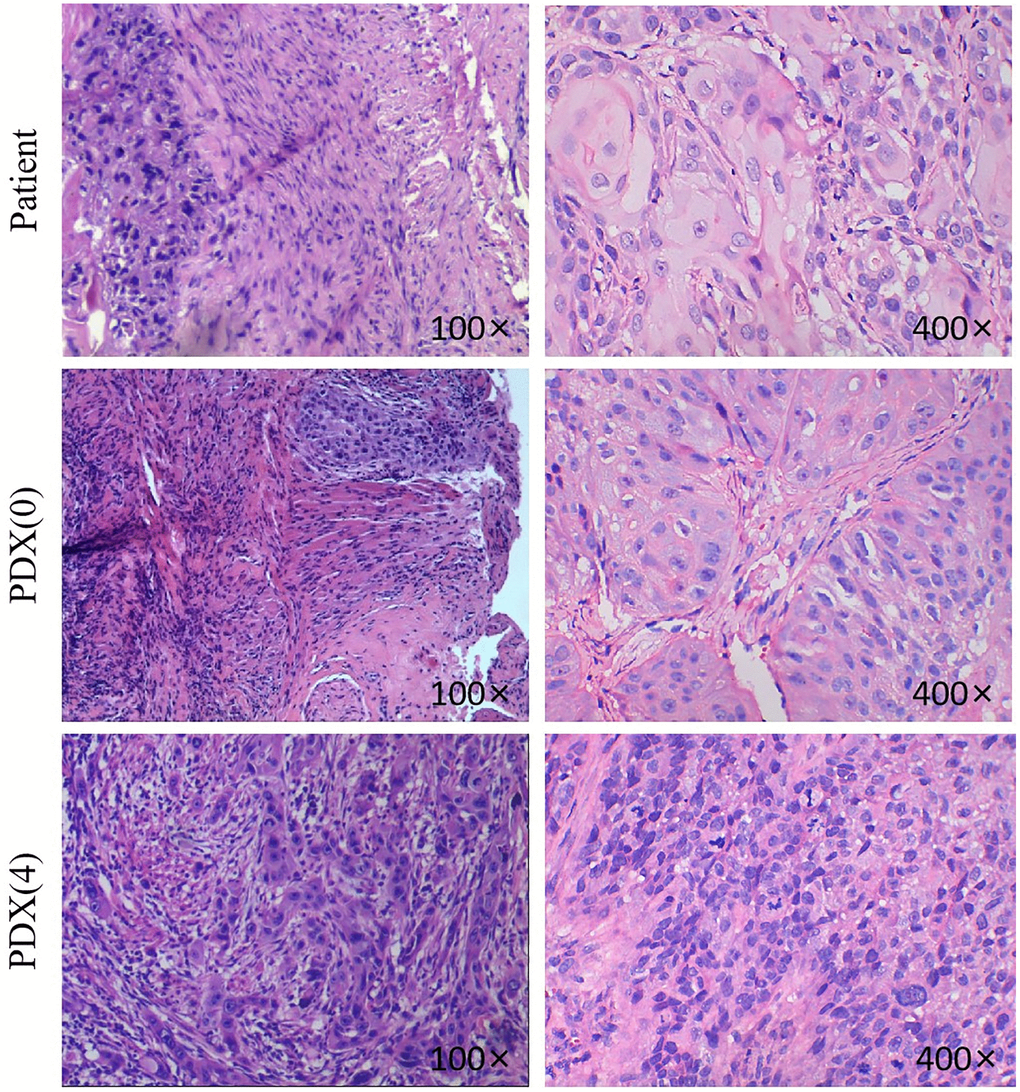 H&E pictures of the TSCC patients and PDX models. Histological analysis of tumor samples. After sacrificing the mice, TSCC tissues from patient and PDX models were fixed and checked with hematoxylin/eosin-staining. Cell nuclei were stained with hematoxylin (purple). The 400x and the 100x were not from the same section.