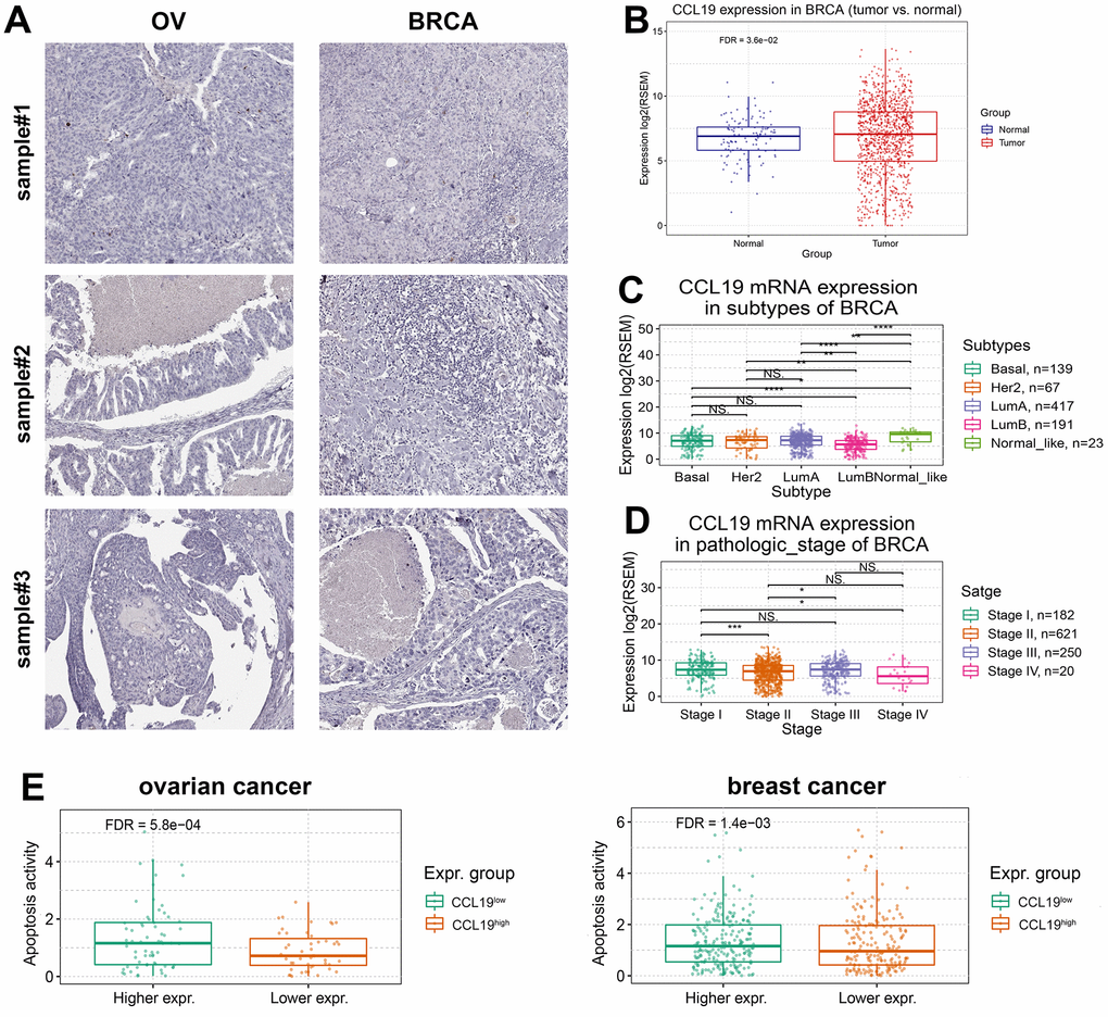 Suppressed CCL19 expression exerts progressive phenotype and apoptosis activity of BRCA and OV. (A) IHC analysis of BRCA and OV samples showed that the expression of CCL19 in normal tissues was higher than that in tumor tissues. (B) Analysis by software package RESM showed that the expression level of CCL19 in normal tissues is lower than that in tumor tissues in breast cancer samples. (C) The difference of CCL19 expression in different subtypes of breast cancer was analyzed. (D) The expression of CCL19 in four clinical stages was observed and compared, and the expression of CCL19 in stage 4 patients was the lowest. (E) Apoptosis activity was tested in CCL19high group and CCL19low group in BRCA and OV. With higher expression of CCL19, the apoptosis activity is higher.