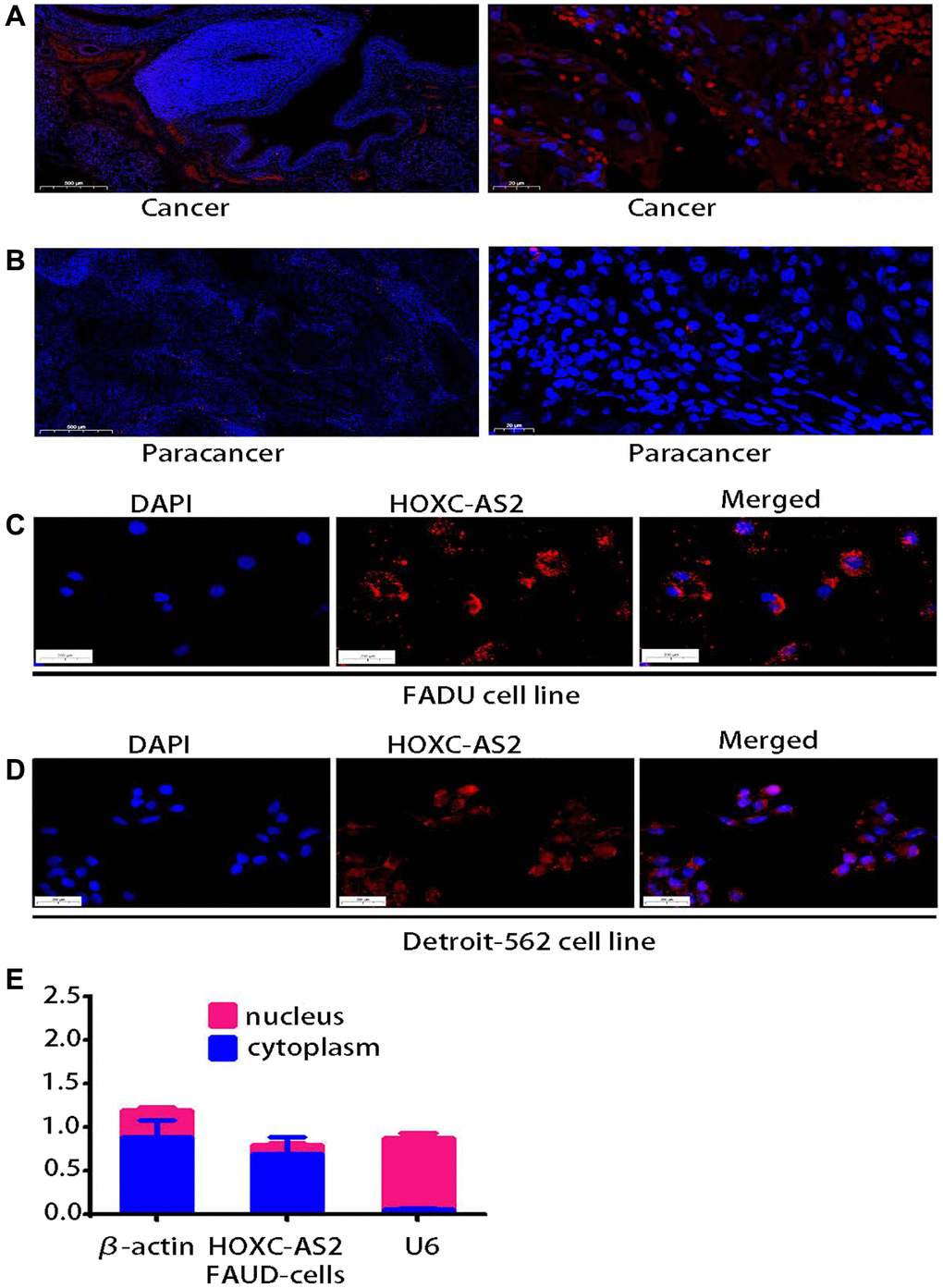 lncRNA HOXC-AS2 was upregulated in human hypopharyngeal carcinoma tissues and localized mainly in the cytoplasm. (A) Representative images of HOXC-AS2 expression in hypopharyngeal carcinoma tissues, as verified by FISH; the scale bars represent 500 μm and 20 μm, respectively. (B) Representative image of HOXC-AS2 expression in normal hypopharyngeal carcinoma-adjacent tissues, as verified by FISH; the scale bars represent 500 μm and 20 μm, respectively. (C) The intracellular localization of HOXC-AS2 was determined by RNA FISH in the FADU cell line. (D) The intracellular localization of HOXC-AS2 was determined by RNA FISH in the Detroit-562 cell line. (E) The nuclear and cytoplasmic distribution of HOXC-AS2 in the FADU cell line was evaluated by qRT-PCR.