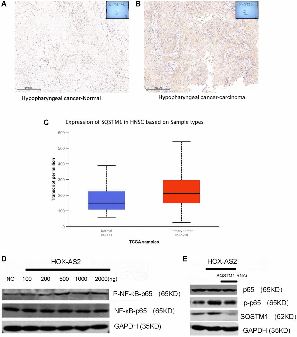 HOXC-AS2 activated the NF-kB signaling pathway by binding to the SQSTM 1 protein. (A) Representative image of P62 protein expression in normal hypopharyngeal carcinoma-adjacent tissue, as evaluated by IHC staining. (B) Representative image of P62 protein expression in hypopharyngeal carcinoma tissue, as evaluated by IHC staining. (C) The expression level of P62 in head and neck squamous cell carcinoma was confirmed by TCGA database analysis. (D) Activation of the NF-KB signaling pathway after HOXC-AS2 overexpression was detected by western blot analysis. (E) The protein expression level of NF-KB was measured by western blot analysis after P62 was knocked down in HOXC-AS2-overexpressing cells.