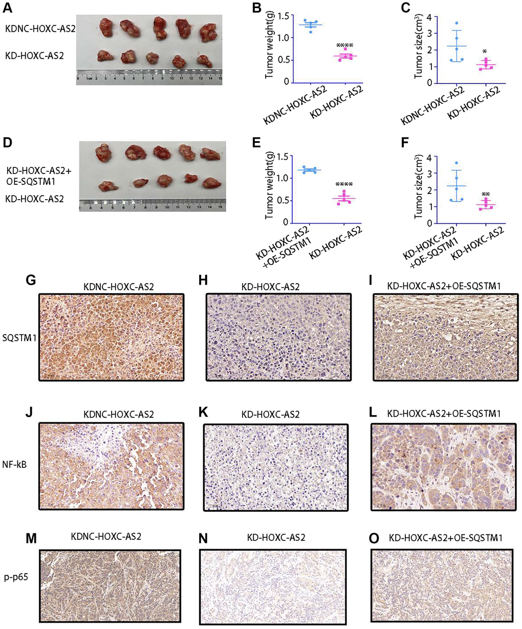 The results of animal experiments confirmed that HOXC-AS2 can promote hypopharyngeal cancer progression. (A–C) Morphological characteristics of subcutaneous xenografts (A), tumor weight (B), and tumor size (C) on day 35 in mice injected with LV-KDNC-HOXC-AS2-D-562 cells and LV-KD-HOXC-AS2-D-562 cells (five mice per group). (D–F) Morphological characteristics of subcutaneous xenografts (D), tumor weight (E), and tumor size (F) on day 35 in mice injected with LV-KD-HOXC-AS2 +OE-P62-D-562 cells and LV-KD-HOXC-AS2-D-562 cells (five mice per group). (G–I) IHC analysis of P62 protein expression in tumors from the LV-KDNC-HOXC-AS2, LV-KD-HOXC-AS, and LV-KD-HOXC-AS2 +OE-P62 groups. (J–L) IHC analysis of NF-kB protein expression in tumors from the LV-KDNC-HOXC-AS2, LV-KD-HOXC-AS, and LV-KD-HOXC-AS2 +OE-P62 groups. (M–O) IHC analysis of p-p65 protein expression in tumors from the LV-KDNC-HOXC-AS2, LV-KD-HOXC-AS, and LV-KD-HOXC-AS2 +OE-P62 groups.