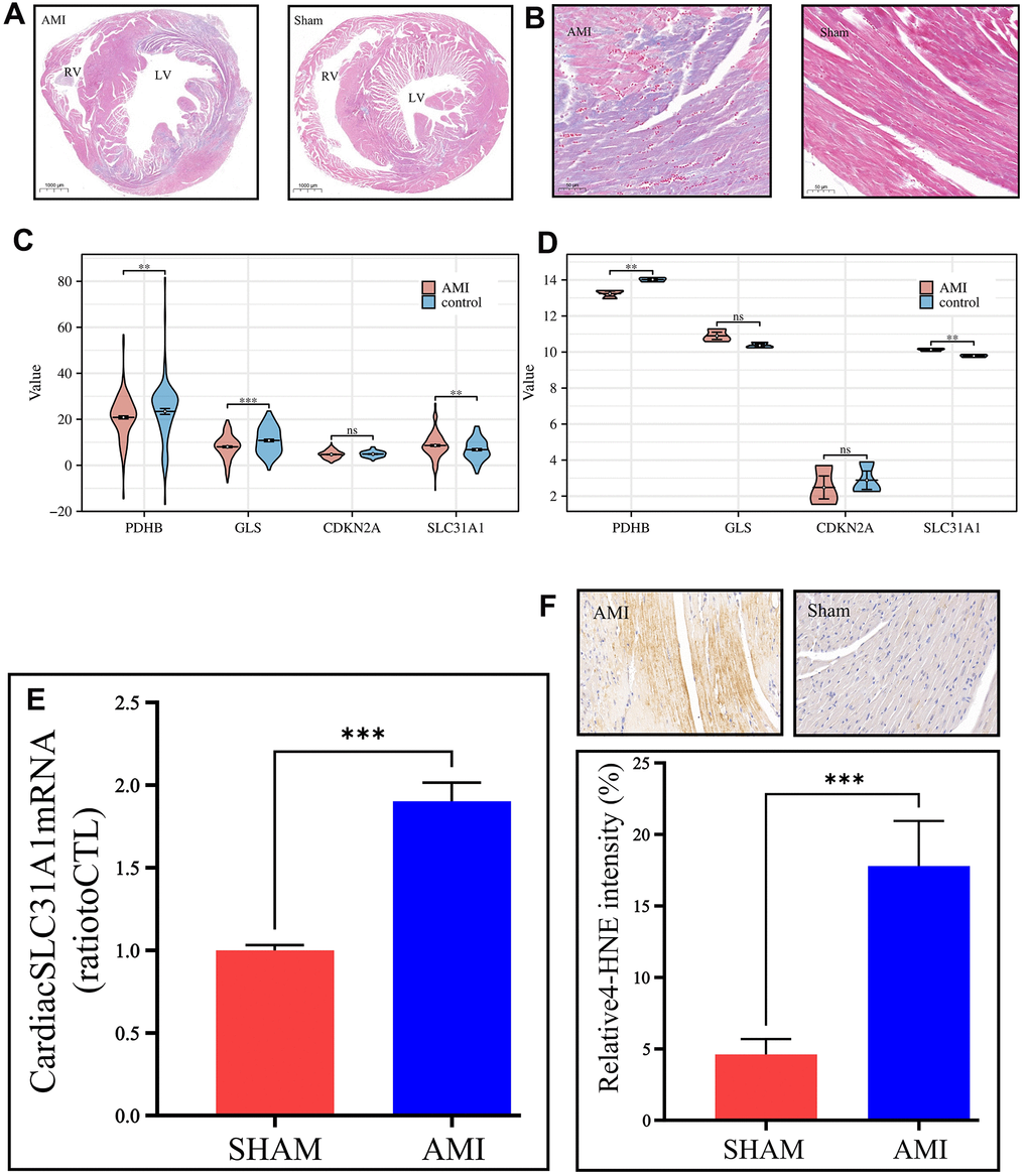 In vivo validation of the expression of the contributor genes, with a focus on the SLC31A1 gene. (A) Masson staining slides on a macroscopic view, demonstrating the coronal section of the mice’s hearts. The left panel is the AMI sample, and the right panel is the Sham sample. RV: right ventricle, LV: left ventricle. (B) Masson staining slides of the coronary heart section of the AMI group and Sham group under magnification. The purplish color indicates hypoxia, thus the area of AMI. The deeper the color, the more severe infarction. (C, D) Expression analysis of the contributor genes in the form of violin plots in the merged GEO dataset and our own bulk RNA sequencing cohort, respectively. (E) qPCR results of the SLC31A1 gene expression. (F) Upper panel: immunohistochemical staining of the SLC31A1 protein in the AMI group and Sham group. The more brownish color, the more abundant the SLC31A1 protein. Lower panel: quantitative analysis of the immunohistochemical staining for the SLC31A1 protein in the AMI group and Sham group in the manner of bar plot.