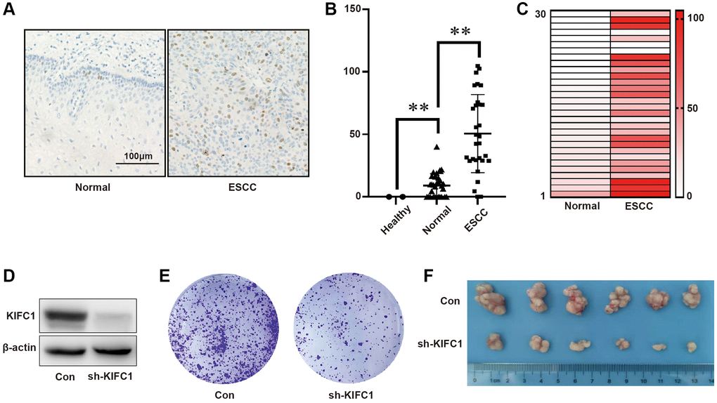 KIFC1 was overexpressed in tumor tissues and facilitates ESCC Proliferation. (A) Immunohistochemical staining is employed to detect KIFC1 protein expression in both healthy and ESCC tissues; (B) The A.H. score is used to statistically analyze KIFC1 protein expression in healthy, adjacent noncancerous, and tumor tissues of the esophagus; (C) Analysis of KIFC1 protein expression in adjacent non-tumor esophageal tissues and their paired ESCC tissues is conducted; (D) Knock down of KIFC1 using shRNA; (E) The influence on clonal formation ability due to knockdown of KIFC1 expression is assessed; (F) In vivo analysis of the proliferative ability associated with KIFC1 is performed. n = 30, **