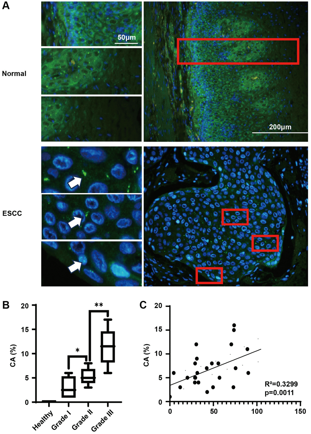 Centrosome amplification in ESCC tissues and paired analysis with KIFC1 expression levels. (A) Centrosome staining in ESCC tissues and adjacent tissues, centrosomes marked using anti-gamma-tubulin antibodies (green) and DNA stained with DAPI (blue); (B) Analysis of centrosome amplification phenomena in relation to tumor grade; (C) Analysis of the relationship between KIFC1 expression levels and rates of centrosome amplification. n = 30, ***