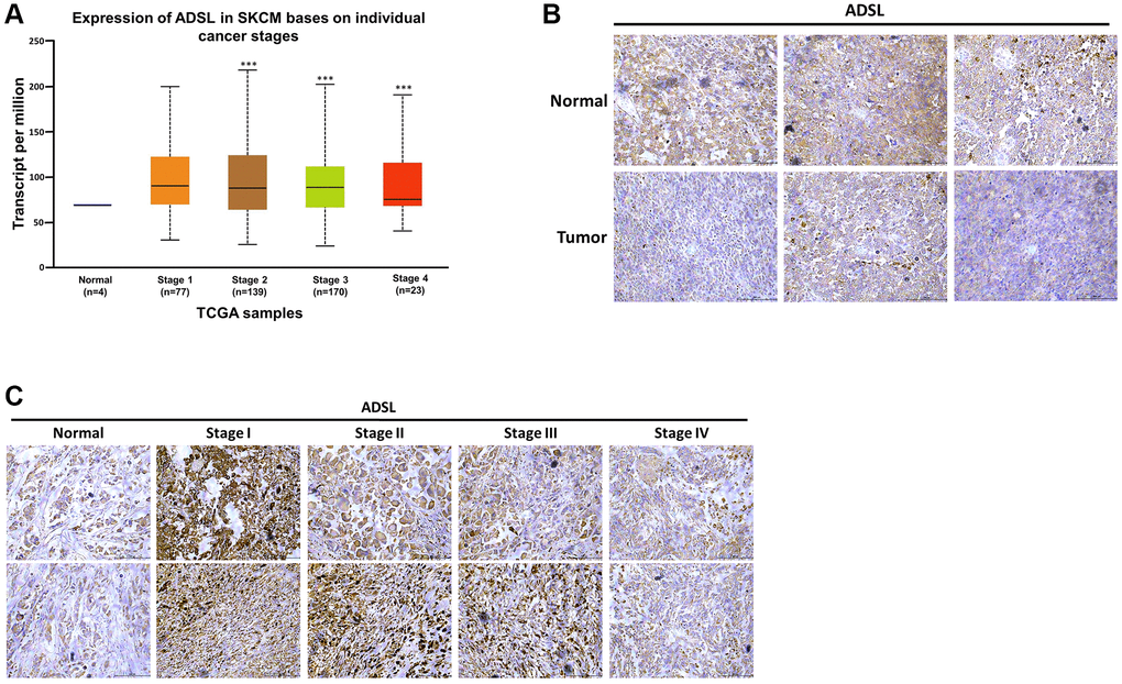 Clinical implications of ADSL expression in human melanoma. (A) Relationship between ADSL expression and melanoma stage. Representative images of IHC staining for ADSL in (B) normal skin tissues and melanoma tissues and (C) in tissues sampled during various stages of melanoma. Scale bar: 500 μm.