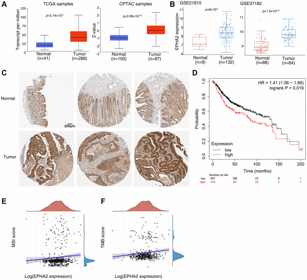 Abnormal expression of EphA2 in colorectal cancer and its relationship with prognosis. (A) Analysis of EphA2 mRNA and protein expression in colorectal cancer tissues and normal tissues using the UALCAN database. (B) Analysis of EphA2 mRNA expression in colorectal cancer tissues and normal tissues using the GEO database. (C) EphA2 expression data from HPA database in colorectal cancer tissues and normal tissues. (D) Overall survival of colorectal patients with differential EphA2 expression. (E, F) Correlation of EphA2 expression with MSI and TMB in colorectal cancer patients.