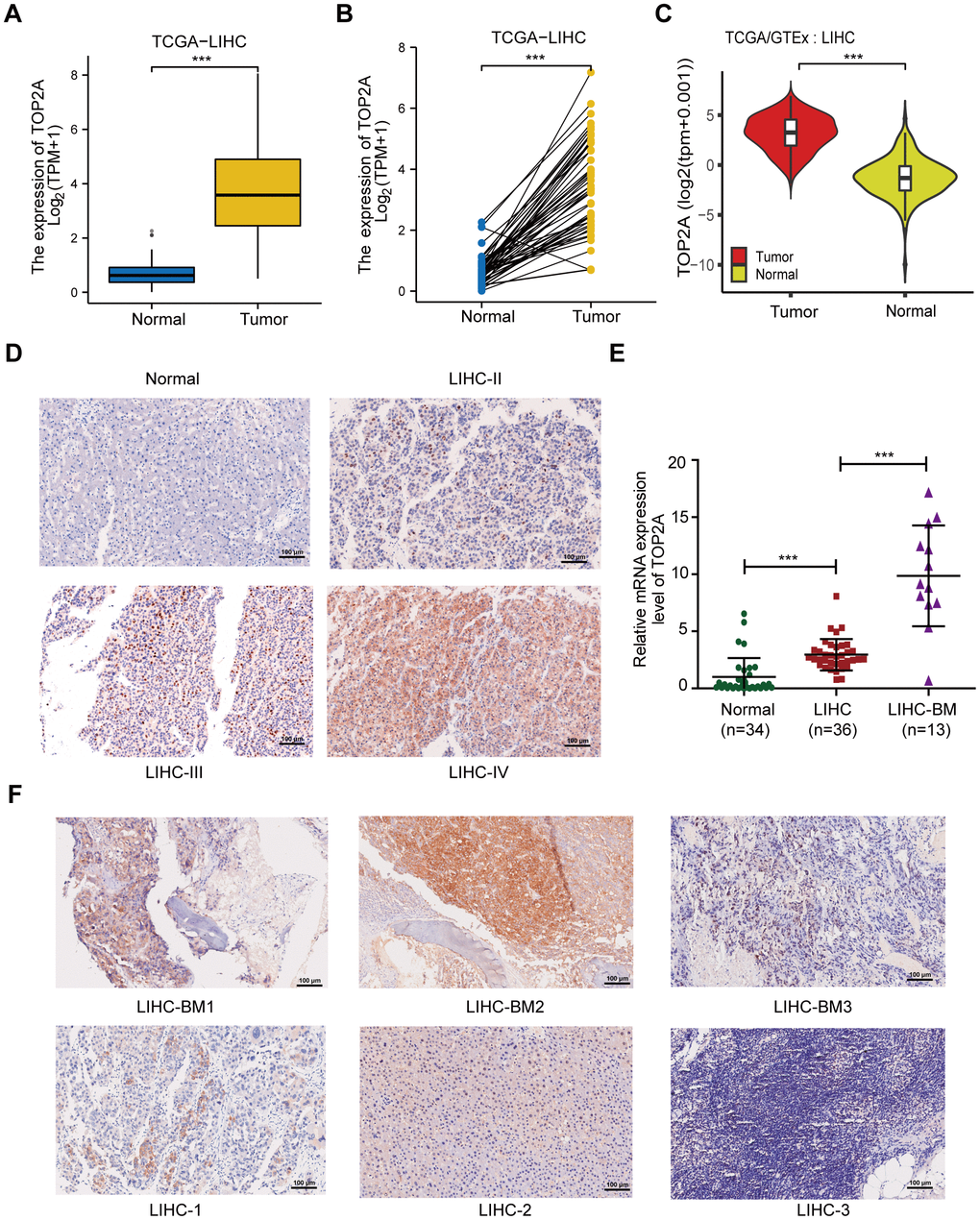The expression of TOP2A in LIHC. (A) The mRNA expression level of TOP2A of LIHC and normal tissues in TCGA database. (B) TOP2A mRNA expression of matched LIHC and normal tissues in TCGA database. (C) The mRNA expression level of TOP2A of LIHC and normal tissues in TCGA and GTEx database. (D) IHC of TOP2A protein expression in LIHC with different stage and normal liver tissues from tissue microarrays. (E) The mRNA expression level of TOP2A of LIHC, LIHC-BM and normal liver tissues in Tianjin Medical University Cancer Institute and Hospital. (F) IHC of TOP2A protein expression in three paired LIHC-BM lesions and counterpart primary LIHC tissues from Tianjin Medical University Cancer Institute and Hospital. Magnification: 200 ×, scale bars: 100 μm. ***P 