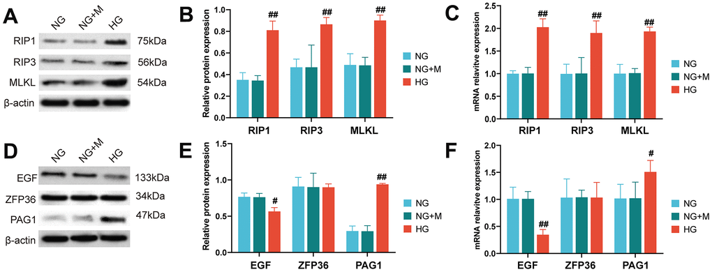 Activation of necroptotic and necroptosis-related biomarkers in HK-2 cells stimulated by high glucose. (A) Western blot assays were used to detect the expression levels of necroptotic proteins in HK-2 cells under different treatments. (B) Bar charts show the grey values obtained from the western blots shown in (A). (C) Reverse transcription quantitative PCR analysis was used to quantify the expression levels of necroptotic gene markers in HK-2 cells treated with NG, NG+M and HG, respectively. The protein and mRNA expression levels of EGF, PAG1 and ZFP36 were detected by western blot analysis (D, E) and reverse transcription quantitative PCR (F) in HK-cells when treated with NG, NG+M and HG. (#P 