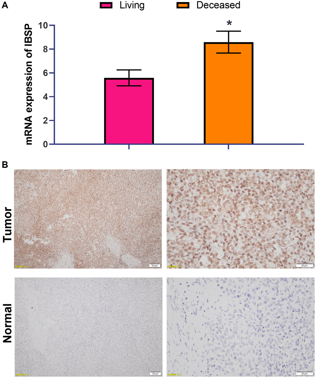 High IBSP expression is associated with poor survival. (A) The prognostic significance of IBSP expression was validated by RT-PCR with another cohort consisting of 21 living patients and 11 deceased patients. (B) The protein expression of IBSP by IHC staining. Scale bar = 50 μm (left panel); scale bar = 20 μm (right panel). *P 