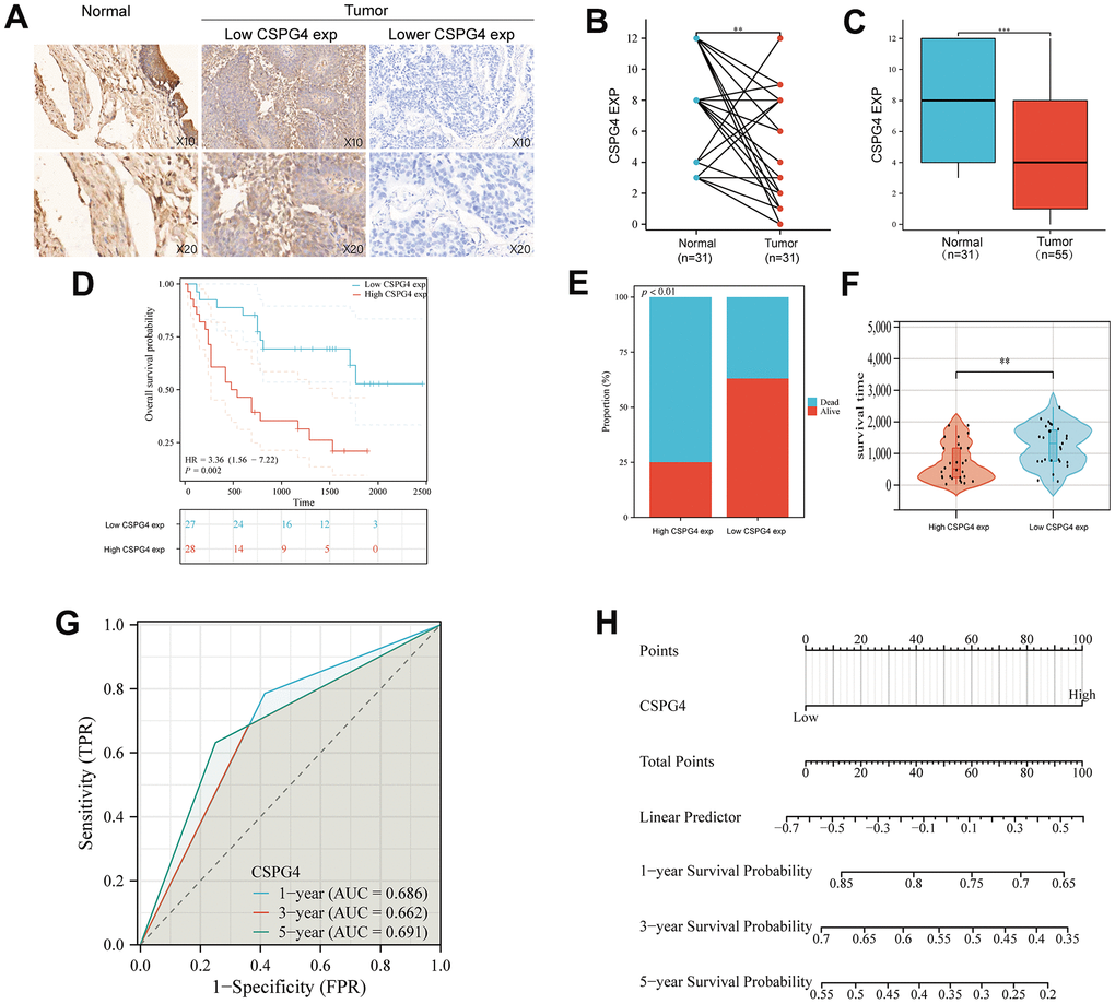Expression of CSPG4 in BLCA and its prognostic validation in patients with BLCA. (A) Immunohistochemical validation of CSPG4 expression in bladder tumors and adjacent normal tissues. (B) CSPG4 expression in bladder tumors and paired normal tissues. (C) CSPG4 expression in bladder tumors and unpaired normal tissues. (D) Prognostic analysis of CSPG4 expression in patients with BLCA. (E) Analysis of the survival and death rate in patients with BLCA exhibiting high and low CSPG4 expression. (F) Impact of CSPG4 expression on survival in patients with BLCA. (G) Predictive analysis of the survival of patients with BLCA in the next one, three, and five years based on CSPG4 expression. (H) Nomogram based on CSPG4 expression for the prognosis of patients with BLCA in the next one, three, and five years.