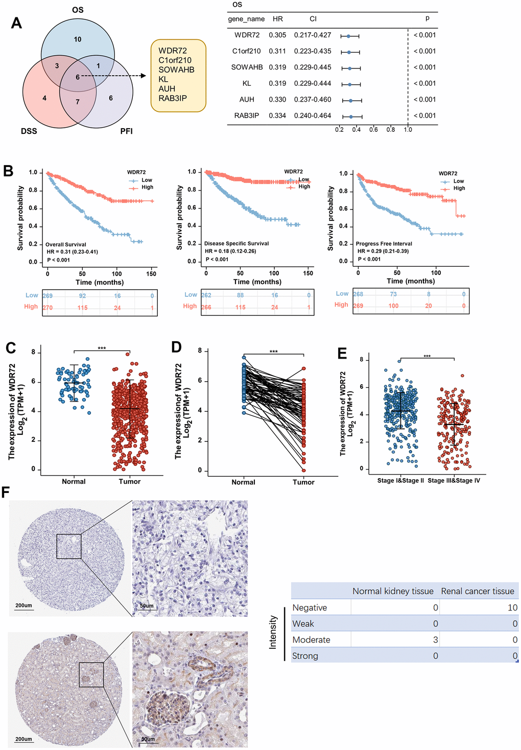 Expression and prognostic significance of WDR72 in ccRCC. (A) Overlapping genes that can improve prognosis including OS, DSS and PFI (top 20 genes) in ccRCC from TCGA data set (Left panel). Overall survival analysis for the prognostic significance of 6 overlapping genes in ccRCC (Right panel). (B) Analysis of the prognostic significance of WDR72 expression in ccRCC patients (OS, left panel; DSS, middle panel; PFI, right panel). (C) WDR72 expression in normal renal tissues and ccRCC tissues. (D) WDR72 expression in ccRCC tissues and paired adjacent normal renal tissues. (E) WDR72 expression in early (I and II) versus late (III and IV) pathological stages in ccRCC. (F) WDR72 protein expression detected by immunohistochemistry staining in RCC tissues (top panel) and normal renal tissues (bottom panel) based on The Human Protein Atlas database (Left panel). Intensity of WDR72 protein was divided into four levels, including Negative, Weak, Moderate and Strong. Abbreviations: WDR72, WD repeat-containing protein 72; ccRCC, clear cell renal cell carcinoma; HR, hazard ratio; CI, confidence interval; OS, overall survival; DSS, disease specific survival; PFI, progress free interval; TCGA, The Cancer Genome Atlas. ***P 