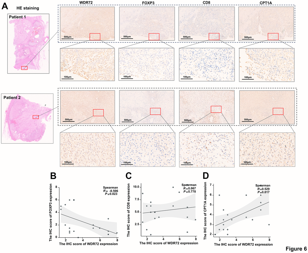 The correlation between the expression of WDR72 and FOXP3, CD8, CPT1A in advanced ccRCC tumor tissues. (A) H&E staining and IHC staining showing expression of WDR72, FOXP3, CD8 and CPT1A in advanced ccRCC tumor tissues. (B–D) Spearman correlation analysis of IHC scores of WDR72 and FOXP3 (B), WDR72 and CD8 (C), as well as WDR72 and CPT1A (D). Abbreviations: FOXP3, Forkhead Box Protein 3; H&E staining, hematoxylin-eosin staining; IHC, immunohistochemistry.