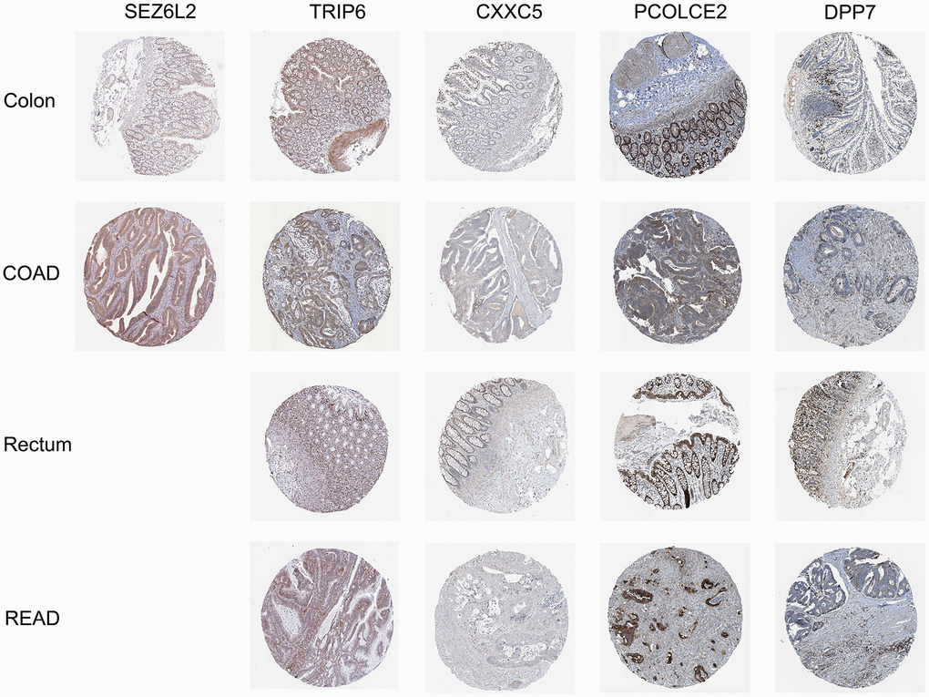 Immunohistochemical stains of the five prognostic genes analyzed from HPA online database.