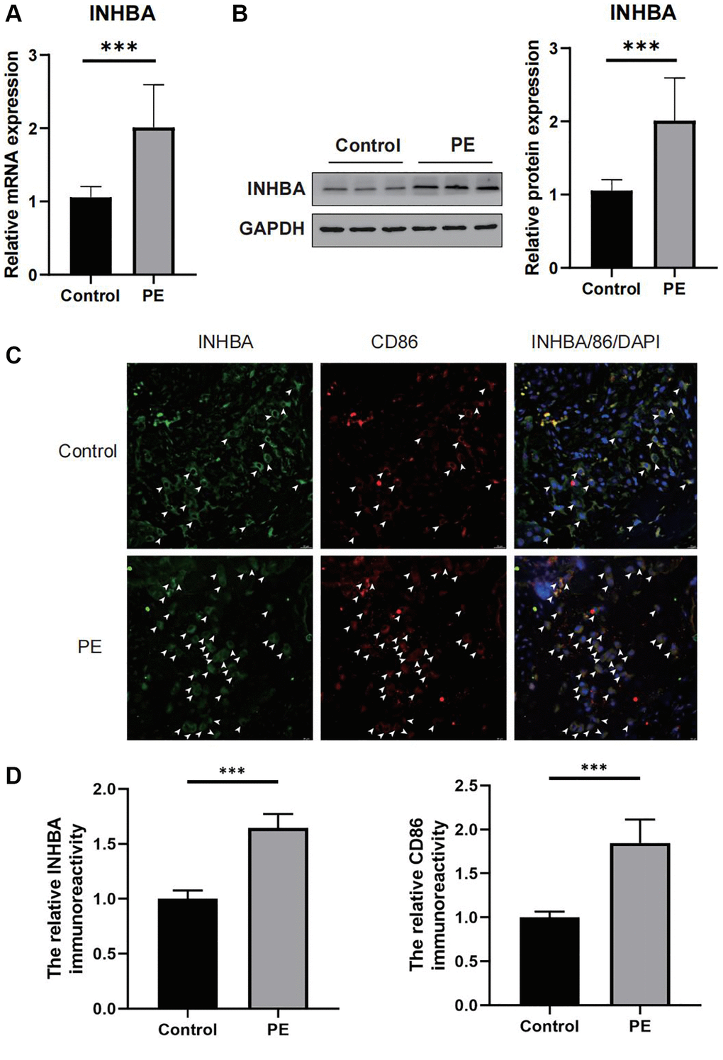 Verifying the abnormal expression of INHBA in preeclampsia (PE) tissues. (A) qPCR results for the expression of INHBA in both PE and control tissues. ***P n = 10. (B) Western blot results for the expression of INHBA in both PE and control tissues. ***P n = 10. (C) Representative immunofluorescent co-localization images of M1 macrophages with INHBA. White arrows indicated positive stained signals. (D) Quantitative analysis results for the relative immunoreactivity of placental INHBA and CD86 in all groups (3 sections for each sample). Scale bar = 20 μm. ***P n = 3.