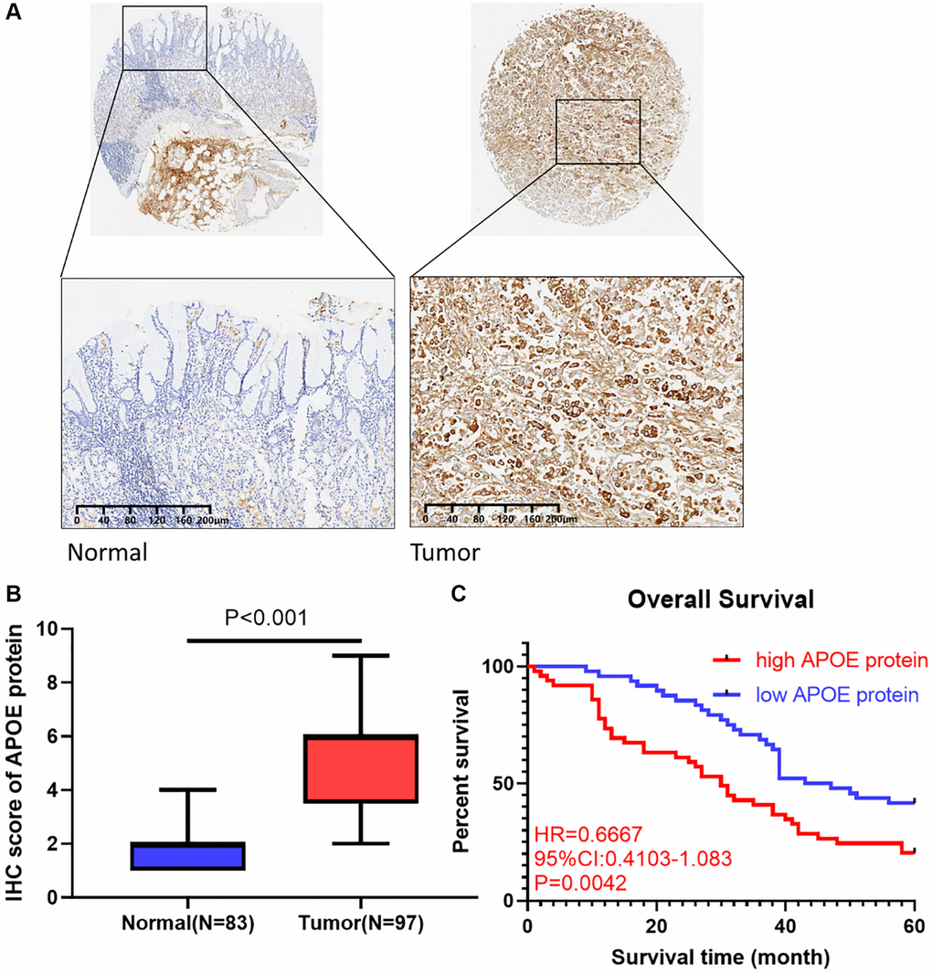 APOE is upregulated in GC clinical samples and correlated with shorter survival in GC patients. (A) Immunohistochemical staining of normal and gastric cancer tissues with anti-APOE antibody. (B) Quantitative analysis of APOE staining shows significantly H-score in gastric tumor samples compared with adjacent normal tissues (83 normal tissues and 97 tumor samples). (C) GC patients with APOE over-expression displayed less favorable overall survival than those with low APOE expression.