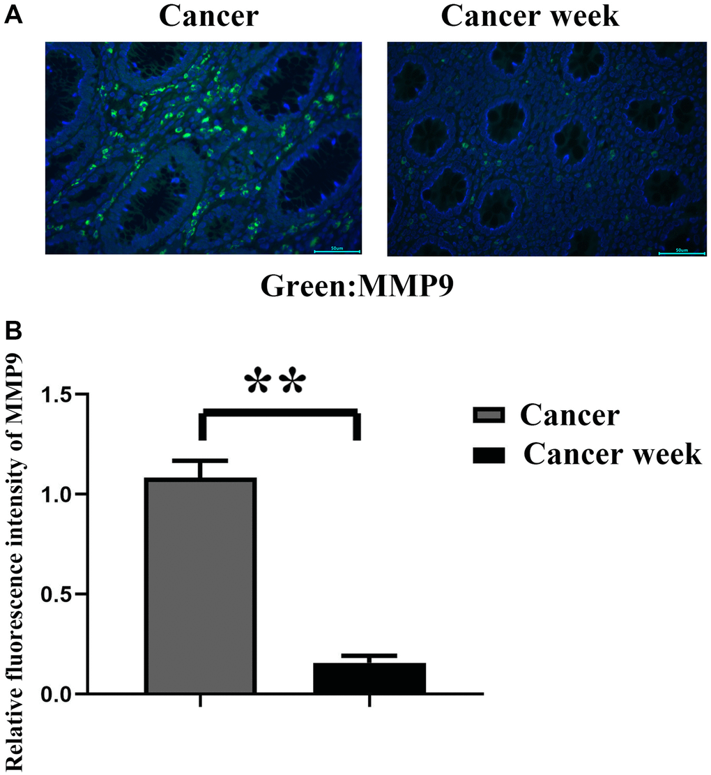 The relative fluorescence intensity of MMP9 in cancer and in peritoneal tissues was detected by immunofluorescence staining. (A) The graph of immunofluorescence results; (B) Statistics for relative fluorescence intensity of MMP9 in cancer and in its peritoneal tissues. **p 