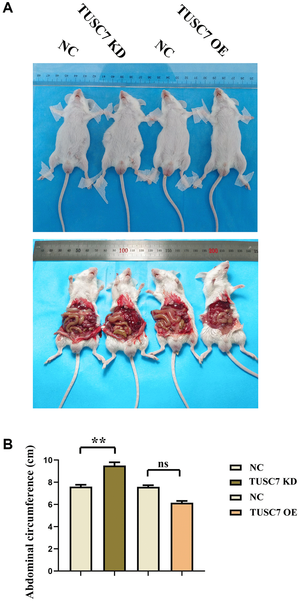 TUSC7 can inhibit the transfer of CRCs. (A) Mouse CRC peritoneal transfer results plot. (B) Statistics of mouse abdominal circumference measurement data. **p 