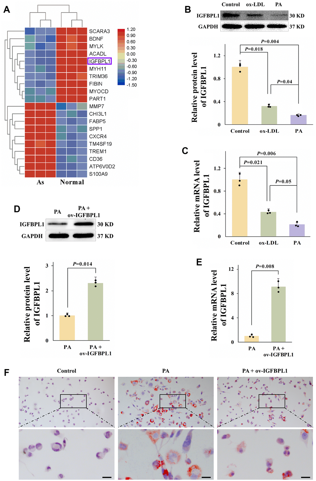 IGFBPL1 inhibits PA-induced lipid accumulation in macrophages. (A) Different expression gene in control samples and unstable atherosclerosis plaque human. Normal: the abdominal aortas intima of three patients without atherosclerosis. Atherosclerosis: aortic plaques of patients diagnosed with grade V or VI atherosclerosis. (B) Relative IGFBPL1 protein level (n=3). (C) Relative mRNA level of IGFBPL1 in PA or ox-LDL treated THP-1 macrophages (n=3). (D) Relative protein level of IGFBPL1 (n=3). (E) Relative IGFBPL1 mRNA level (n=3). (F) Representative images of oil red O staining. PA: palmitic acid, THP-1 macrophages were incubated with 100 μM PA for 48 h. ox-LDL: oxidized low density lipoprotein, THP-1 macrophages were treated with 100 μg/mL ox-LDL for 72 h. PA + ov-IGFBPL1, THP-1 was transfected with over-expression plasmid of IGFBPL1 for 24 h and then incubated with 100 μM PA for 48 h. P