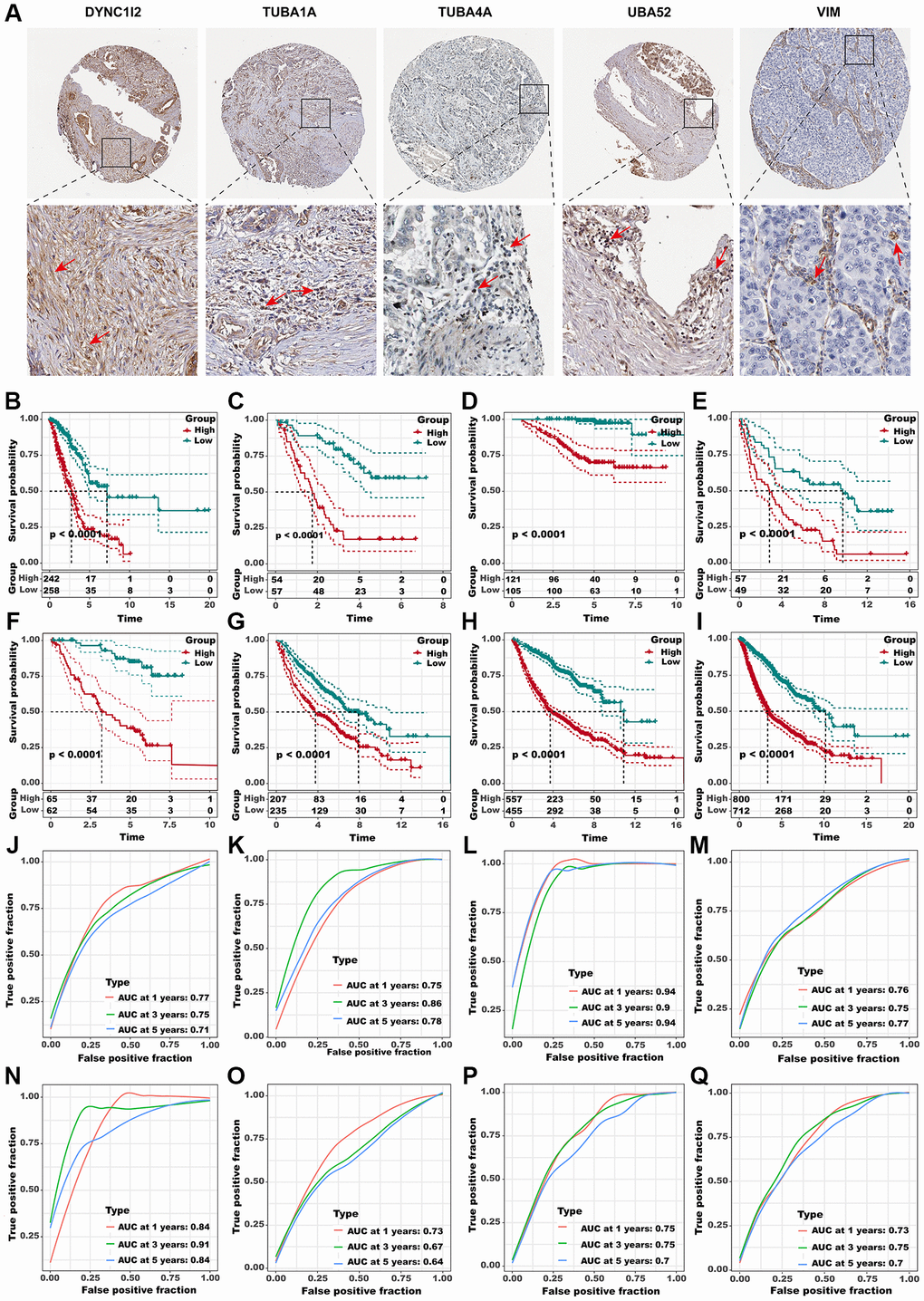 Identification of the hub predictive genes to construct ADPS. (A) IHC staining images of five crucial aggrephagy genes. Panel1: DYNC1I2+ fibroblasts were marked with a red arrow. Protein was mainly expressed on cell membrane (source HPA. Patient ID: 448, female, age 76 years). Panel2: TUBA1A+ T cells were marked with a red arrow. Protein was mainly expressed on cytoplasmic/membranous (source HPA. Patient ID: 448, female, age 76 years). Panel3: TUBA4A+ T cells were marked with a red arrow. Protein was mainly expressed on cytoplasmic/membranous (source HPA. Patient ID: 2403, female, age 65 years). Panel4: UBA52+ T cells were marked with red arrows. Protein was mainly expressed in the nucleus (source HPA. Patient ID: 2393, female, age 54 years). Panel5: VIM + Macrophages were marked with red arrows. Protein was mainly expressed in the cytoplasmic/membranous (source HPA. Patient ID: 1421, female, age 76 years). (B–I) Kaplan-Meier survival curves of the ADPS regarding OS in the TCGA (B), GSE3141 (C), GSE31210 (D), GSE37745 (E), GSE50081 (F), GSE68465 (G), MetaGEO (H), and Meta cohorts (I). (J–Q) Time-dependent ROC curves of the ADPS regarding 1-, 3-, and 5-year OS in the TCGA (J), GSE3141 (K), GSE31210 (L), GSE37745 (M), GSE50081 (N), GSE68465 (O), MetaGEO (P), and Meta cohorts (Q).