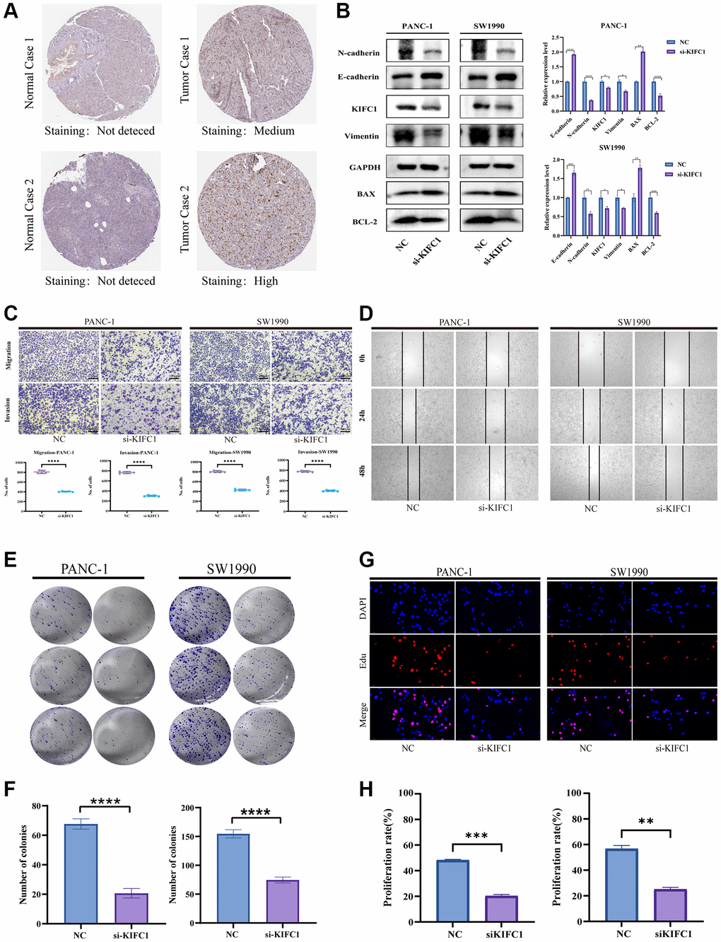 Effects of KIFC1 on malignant phenotypes of PANC-1 and SW1990 cells. (A) Immunohistochemistry of KIFC1 in pancreatic cancer tumor tissues and corresponding adjacent normal tissues. (B) Western blot analysis of KIFC1 knockdown. (C) Transwell for testing migration and invasion ability. (D) Scratch assay for determining cell migration. (E, F) Proliferation attenuation of PANC-1 and SW1990 cells was detected by colony formation assay. (G, H) Proliferation attenuation of PANC-1 and SW1990 cells was detected by Edu assay. Ns: p ≥ 0.05; *p **p ***p ****p 