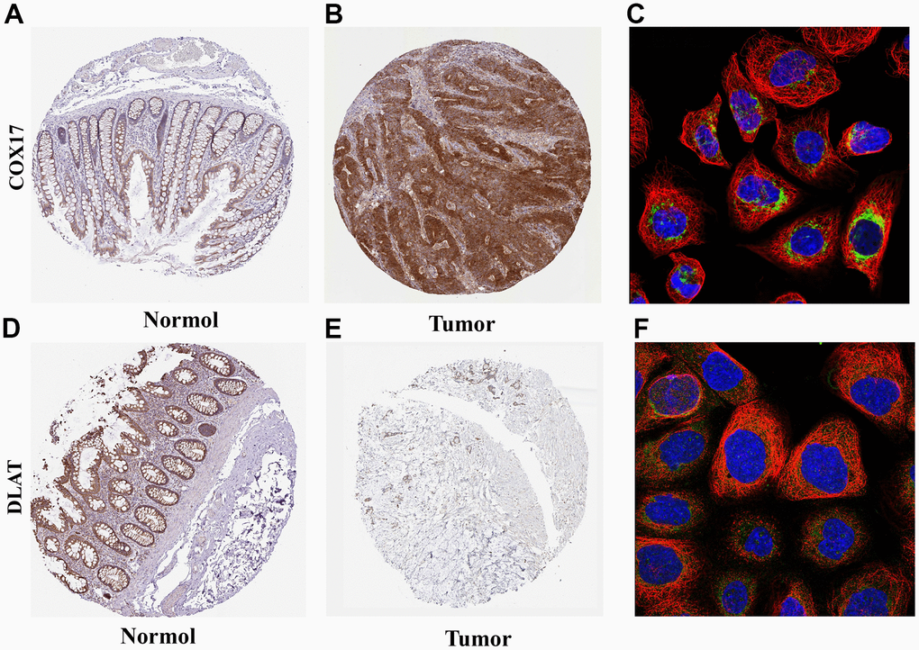 Expression and subcellular localization of COX17 and DLAT (A) The expression of COX17 is greater in tumor tissues compared to (B) normal tissues. (C) COX17 was mainly located in mitochondria. DLAT expression in (D) CRC and (E) normal issues. (F) DLAT were mainly located in the mitochondria by the HPA database analysis.