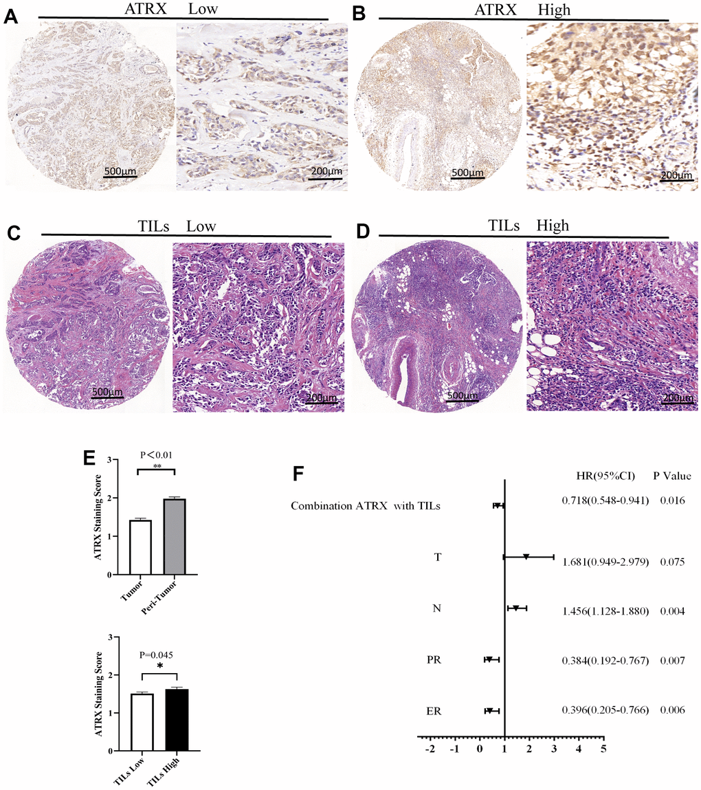 ATRX and TILs on the TMA of BC. Representative images for ATRX low (A) and ATRX high (B) in the samples. Representative images for TILs low (C) and TILs high (D) in the samples. The images of (A, C) came from the same sample, while the ones of (B, D) came from another sample. (E) Statistical analysis of ATRX expression. (F) Univariate analysis screened risk factors for OS in patients with BC.
