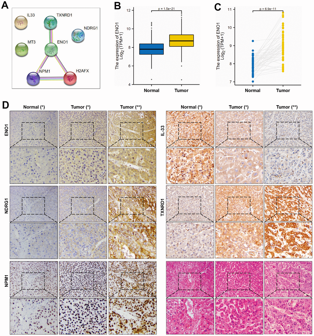 ENO1, NDGR1 and NPM1 expression in HCC tissues. (A) PPI network identifies ENO1 as hub gene of signature. (B, C) The expression of ENO1 gene in paracellular tissues and hepatocellular carcinoma tissues. (D) The protein expression of ENO1, NDGR1, NPM1, TXNRD1 and IL-33 in hepatocellular carcinoma tissues and paracellular tissues (n= 10 per group). Samples were stained with H&E staining to observe the structure of paracellular tissues and hepatocellular carcinoma tissues (n= 10 per group). Patients’ essential characteristics were shown in Supplementary Table 4. Normal (*): paracellular tissues; Tumor (*): hepatocellular carcinoma tissues, EDMONDSON Classification: II; Microvascular tumor thrombus: MVI grade 0; Tumor (**): hepatocellular carcinoma tissues, EDMONDSON Classification: III-IV; Microvascular tumor thrombus: MVI grade 1.