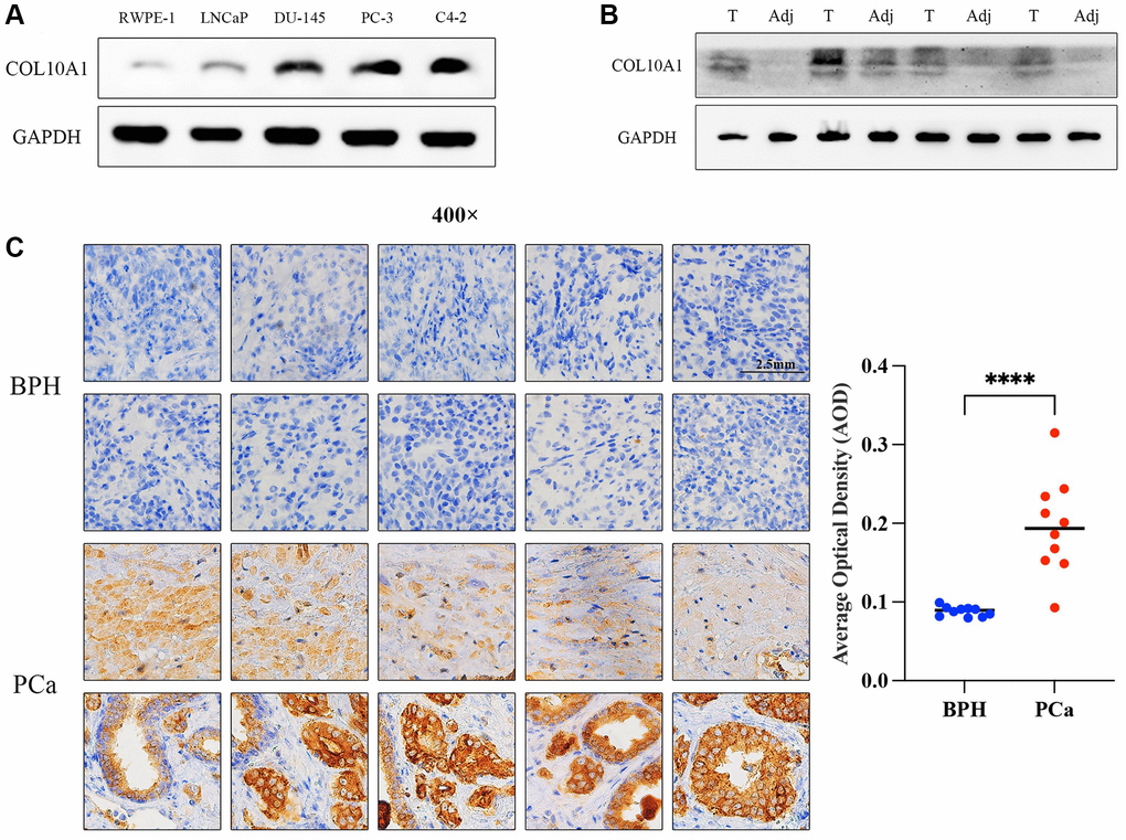 COL10A1 highly expressed in prostate cancer cell lines and tissues. The Western Blot assay was performed the expression of COL10A1 with RWPE-1, LNCaP, DU-145, PC-3 and C4-2 cell lines (A). The Western Blot assay was performed the expression of COL10A1 with 4 pairs of prostate cancer specimens and adjacent tissues specimens (B). Immunohistochemistry analysis of COL10A1 protein expression in 10 pairs of the prostate cancer tissues and BPH tissues (C).