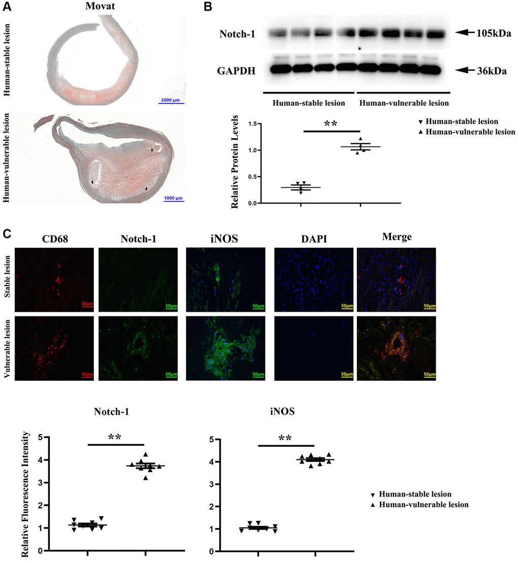 Notch-1 was significantly increased in the human vulnerable atherosclerotic lesion. (A) Representative images of the human vulnerable atherosclerotic lesion and stable lesion. In the representative images of the human vulnerable atherosclerotic lesion, thinning of fibrous caps, enlargement of lipid core and necrotic sites, and macrophage increase could be observed. (B) Western blotting and quantitative analysis revealed that the Notch-1 expression was significantly enhanced in the human vulnerable atherosclerotic lesion. **P C) Immunofluorescence microscopy, and quantitative analysis revealed increased immunofluorescence of Notch-1 and iNOS in macrophages of the human vulnerable atherosclerotic lesion compared with the stable lesion. **P 