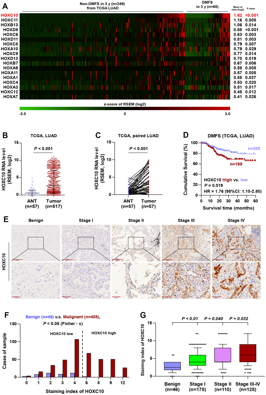 HOXC10 is upregulated in LUAD. (A) High expression of HOX genes in LUAD tissues with distant metastasis by analyzing the dataset of LUAD from TCGA. (B) Comparison of HOXC10 RNA expression between LUAD tissues and the adjacent normal tissues (ANT) in TCGA. (C) Comparison of HOXC10 RNA expression between LUAD tissues and the matched adjacent normal tissues (ANT) in TCGA. (D) Kaplan-Meier survival analysis of DMFS in LUAD patients with low HOXC10 expression versus high HOXC10 expression. (E) Representative images of HOXC10 immunostaining in 46 benign lung lesion and 408 LUAD tissues. (F) The number of lung tissues stratified by staining index of HOXC10. (G) Staining index of HOXC10 in different pathological stage of LUAD.