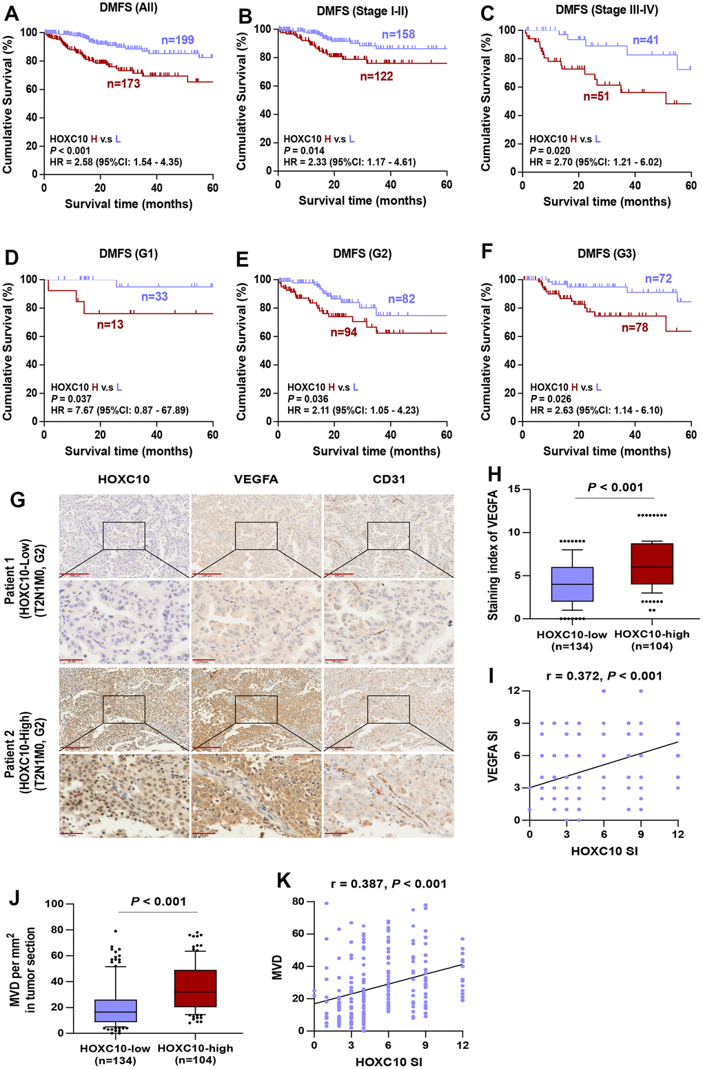 High expression of HOXC10 in LUDA tissues represents a worse DMFS. (A–C) Kaplan-Meier survival analysis of DMFS in all stage, stage I-II, and stage III-IV of LUAD patients with low HOXC10 expression versus high HOXC10 expression. (D–F) Kaplan-Meier survival analysis of DMFS in grade I, grade II, and grade III of LUAD patients with low HOXC10 expression versus high HOXC10 expression. (G) Representative IHC images of HOXC10, VEGFA and CD31 expression in LUAD tissues. (H) Staining index of VEGFA in HOXC10-low and HOXC10-high expression LUAD patients. Error bar represents the 10th-90th percentile. (I) The correlation between HOXC10 expression and VEGFA expression in LUAD samples. (J) MVD in HOXC10-low and HOXC10-high expression LUAD patients. (K) The correlation between HOXC10 expression and MVD in LUAD samples.