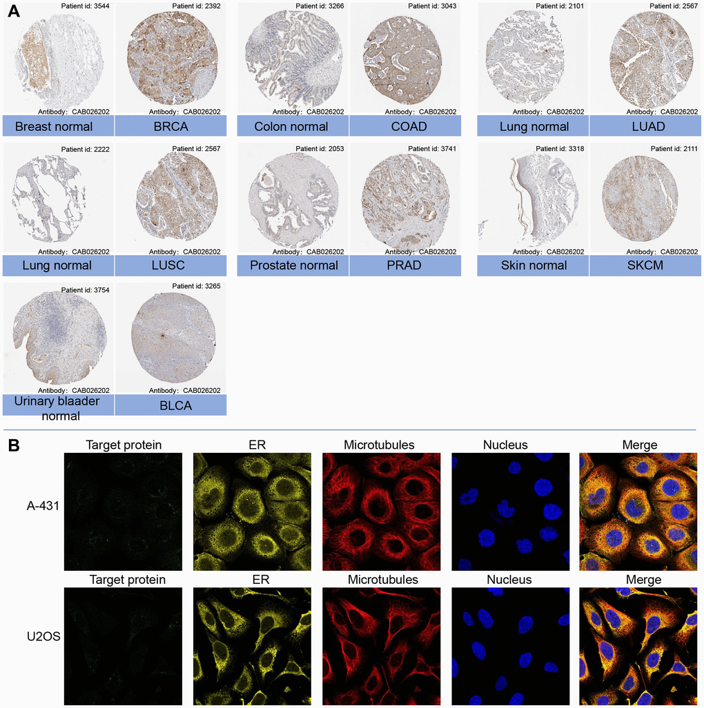 (A) Representative immunohistochemical staining (IHC) of LTBR in various normal (left) and tumor (right) tissues from Human Protein Atlas. (B) Protein subcellular localization the immunofluorescence images of LTBR protein from Human Protein Atlas.