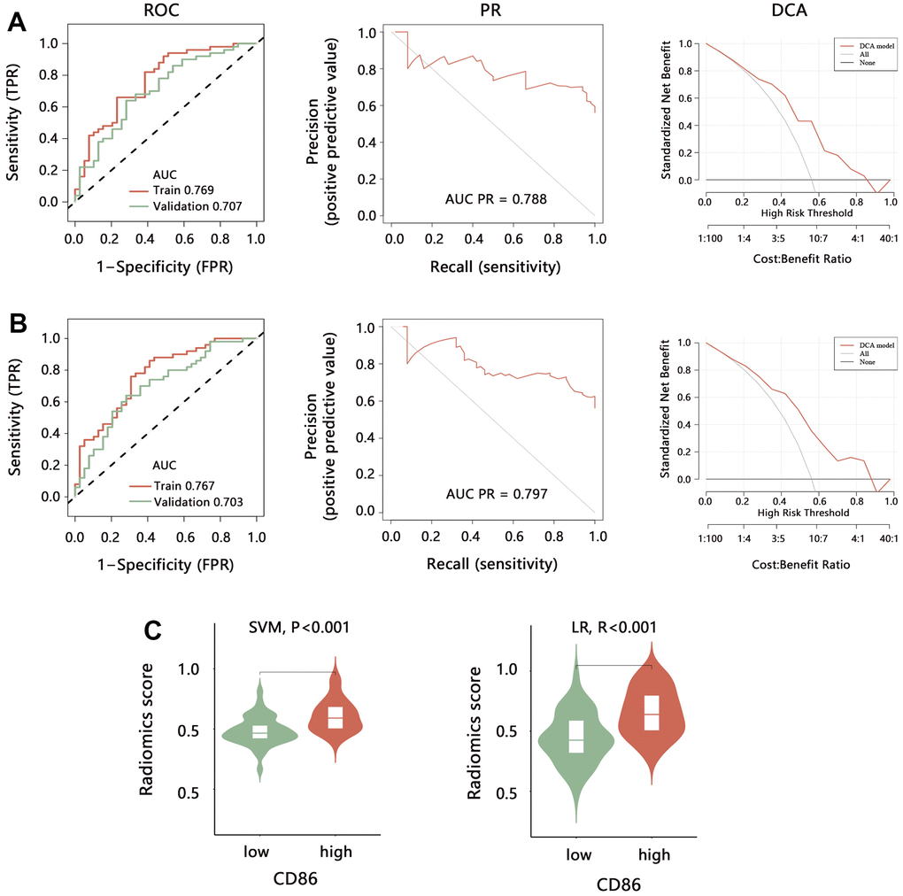 Performance evaluation of radiomics model for predicting the CD86 expression. The ROC, PR, and DCA analyses were performed to evaluate the model performance established by (A) SVM and (B) LR method in training set and validation set. (C) The difference in radiomics score between CD86 high and low expression groups. Abbreviation: SVM, Support Vector Machine; LR, Logistic regression; ROC, receiver operating characteristic curve; PR, precision-recall curve; DCA, decision curve analysis; AUC, area under curve.