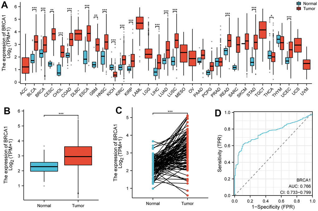 The expression level of BRCA1 in tumors. (A) BRCA1 was highly expressed in many solid tumors, including BRCA (B, C). The ROC curve area was 0.766 (D), indicating BRCA1 was a biomarker of diagnostic of BRCA. P-values were calculated with two-tailed unpaired Student’s t-test, *p p p 