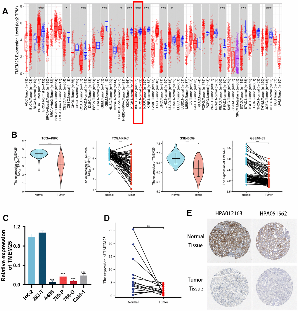 Differential expression of RNA levels and protein levels of TMEM25 in ccRCC. (A) Pan-cancer analysis showed that differential expression of TMEM25 RNA levels was present in a variety of cancers, including renal clear cell carcinoma, which showed a significant low expression status. (B) TCGA-KIRC, GSE46699 and GSE40435 cohort differential analysis consistently showed that TMEM25 expression was significantly lower in ccRCC than in normal tissues. (C) Compared with normal renal tubular epithelial cells (HK-2) and the human embryonic kidney cell line(293-T), TMEM25 was also lowly expressed in renal cancer cell lines. (D) The results of the samples from our study center also further confirmed that TMEM25 was expressed much less in ccRCC. (E) The HPA database demonstrated that TMEM25 expression in ccRCC tissues is significantly lower than that in normal tissues. (*p 