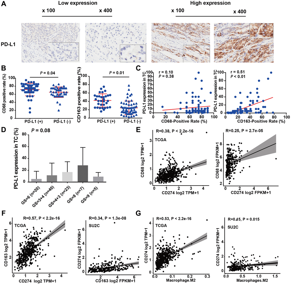M2-TAMs infiltration was positively associated with PD-L1 expression. (A) Representative IHC images of PCa tissue slides with low (left panel) or high (right panel) levels of PD-L1 protein. (B) Dot plot shows the expression of CD68 in PD-L1 (+) and PD-L1 (−) PCa (Student’s t-test). (C) Dot plot shows the expression of CD163 in PD-L1 (+) and PD-L1 (−) PCa (Student’s t-test). (D) Bar plot showed PD-L1 protein expression increasing with Gleason score (ANOVA test). (E) Correlation between CD274 mRNA (encoding PD-L1) and CD68 mRNA in TCGA-PRAD and prad