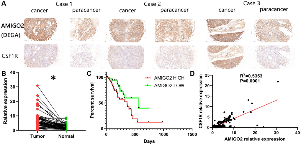 (A) Representative immunohistochemical imagines of AMIGO2 and CSF1R in cancer and paracancerous tissue; *p B) The mRNA expression of AMIGO2 in caner and paracancerous tissue. (C) Survival analysis of AMIGO2. (D) The correlation between the mRNA expression of CSF1R and AMIGO2 in cancer and paracancerous tissue.