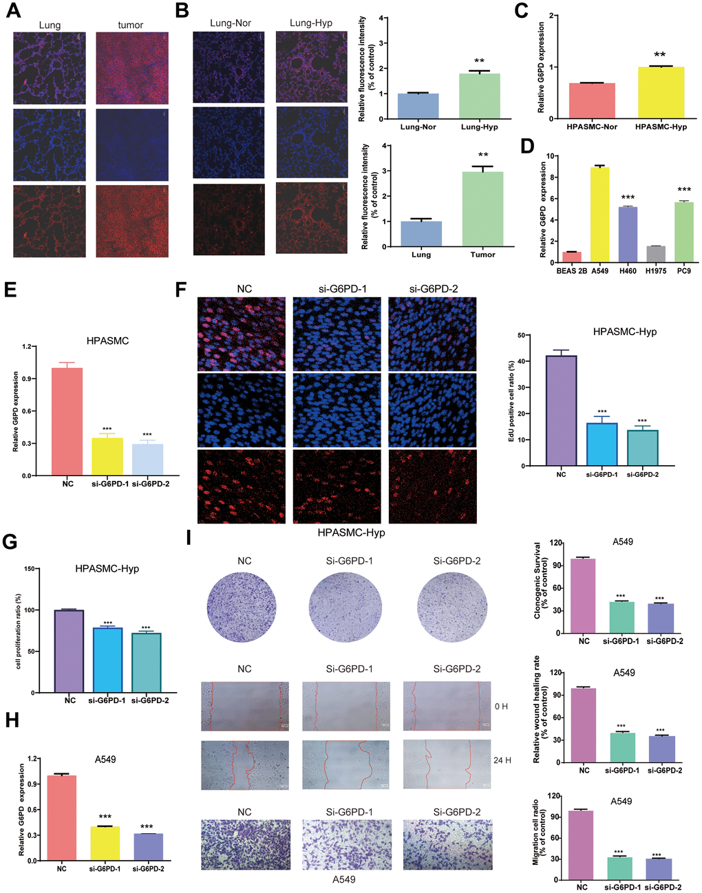 Identification of G6PD mRNA expression in LUAD and PAH. (A) The expression of G6PD in the tumors and lung organs through immunofluorescence imaging (n = 3). (B) The expression of G6PD in hypoxia-induced PAH tissues and normal lung tissue through immunofluorescence imaging (n = 3). (C, D) G6PD expression levels in normal cells and hypoxia cells (C), and LUAD four cell lines (D). (E) qRT-PCR analysis of G6PD expression in HPASMC transduced with siRNA. (F) EDU assay in transduced hypoxia cells. (G) CCK8 assay in transduced hypoxia cells. (H) qRT-PCR analysis of G6PD expression in A549 cell transduced with siRNA. (I) Colony formation assay and transwell assay of migration/invasion ability in transduced A549 cell.