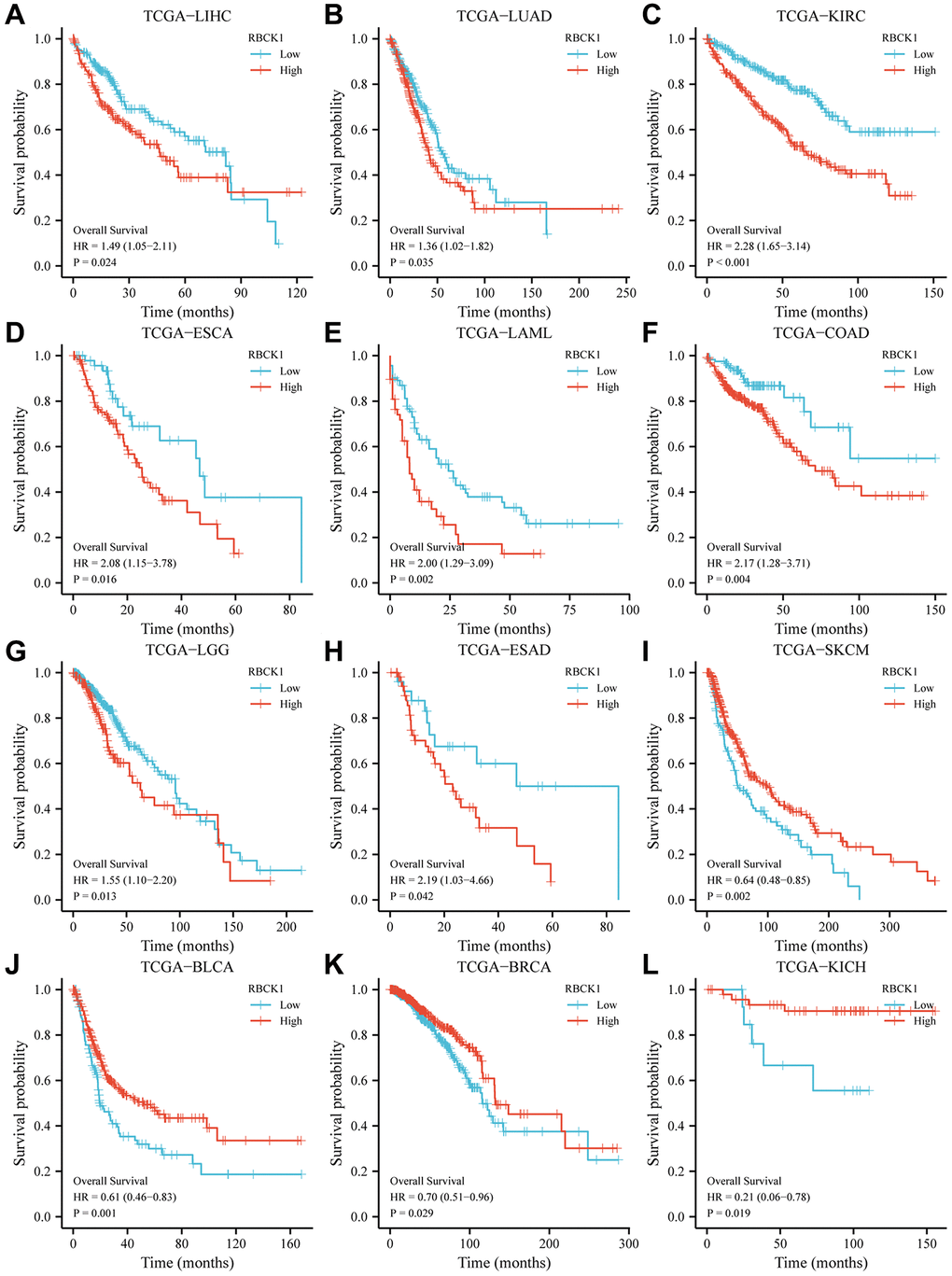 High RBCK1 expression is generally associated with poor prognosis in various carcinomas. Kaplan-Meier plots and statistical analysis based on the work of the TCGA Firehose Legacy study, showing the effect of increased RBCK mRNA expression within LIHC (A), LUAD (B), KIRC (C), ESCA (D), LAML (E), COAD (F), LGG (G), ESAD (H), SKCM (I), BLCA (J), BRCA (K) and KICH (L) on overall survival.