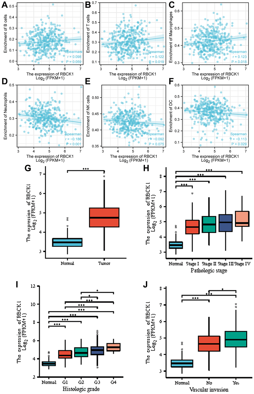 Correlation analysis between RBCK1 levels and clinicopathological characteristics of HCC patients. (A–F), relationship between RBCK1 and B cells (A) T cells (B) Macrophages (C) Neutrophils (D) NK cells (E) and DC (F). (G) RBCK1 is overexpressed in HCC patients. (H–J) clinical analysis the relationship between RBCK1 and histologic grade (H) pathologic stage (I) and vascular invasion (J) of HCC.