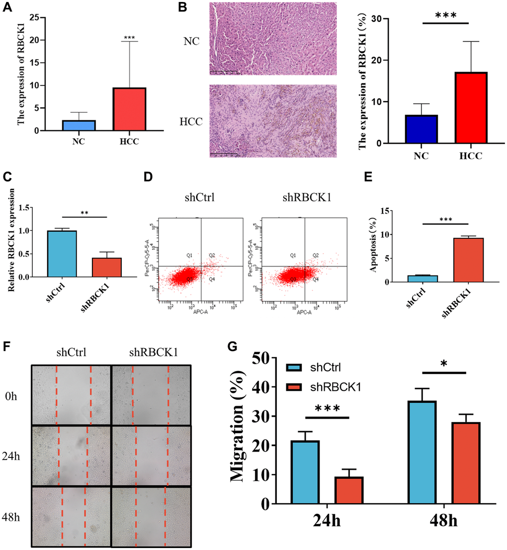 Knockdown of RBCK1 inhibits cell proliferation and promotes apoptosis in HCC cell lines. (A, B) RBCK1 expression in 30 cases of HCC and its adjacent tissues from the First Affiliated Hospital of Guangxi Medical University by qRT-PCR (A) and IHC (B). (C) The knockdown efficiency of the RBCK1 gene. (D, E) The level of apoptosis in Huh7 cells after RBCK1 gene knockdown. (F, G) The cell scratch assay was performed to evaluate the migration ability of Huh7 cells after RBCK1 gene knockdown.