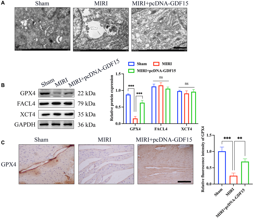The ferroptosis induced by MIRI was remarkably alleviated by pc-DNA-GDF15. (A) Detection of mitochondrial damage with TEM (bar: 100 nm); (B) Relative protein expression levels of GPX4, FACL4, and XCT4 in heart tissues. (C) IHC staining of GPX4 in the heart tissues (bar: 200 μm, magnification: 100×). *P **P ***P 