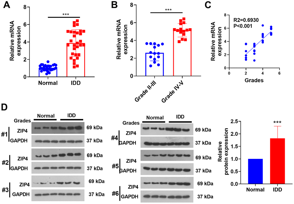 ZIP4 expression in the NP tissues of IDD patients. The NP tissues of IDD patients and normal patients were collected. (A) RT-PCR was used to ascertain the ZIP4 mRNA profile. (B) ZIP4 mRNA levels in different grades of IDD patients. (C) Correlation between ZIP4 mRNA level and grades of IDD patients. (D) Western blotting was used to detect ZIP4 protein level in the NP tissues of both IDD and normal patients. N=3. ***P